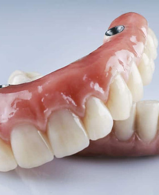 Prótesis híbrida de arcada completa sobre implantes dentales