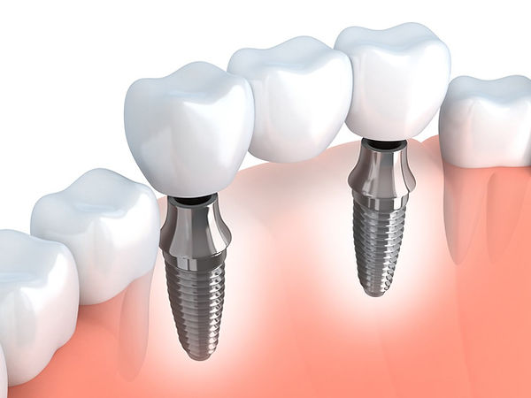 puente implantes.jpg